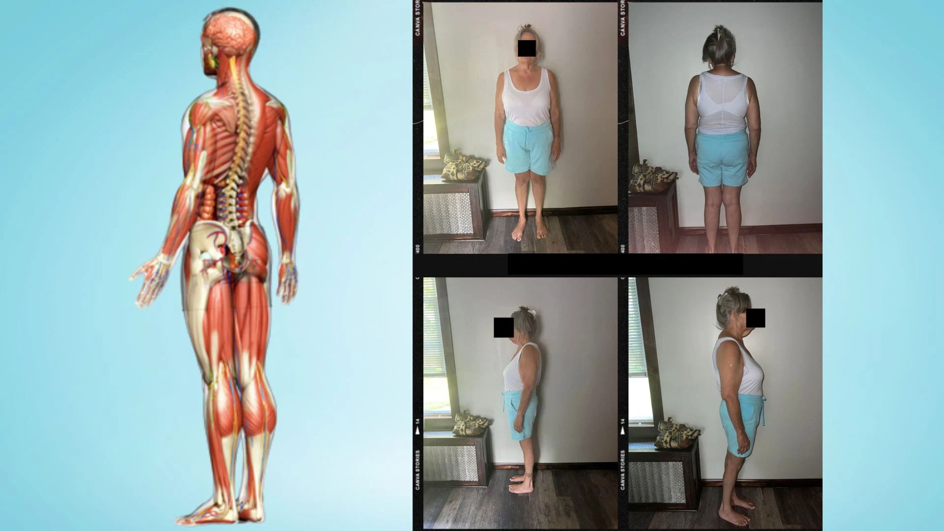 P-Ray personalized posture assessment