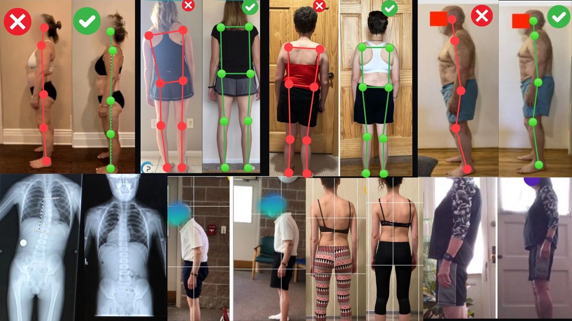 Before-and-after posture and alignment examples